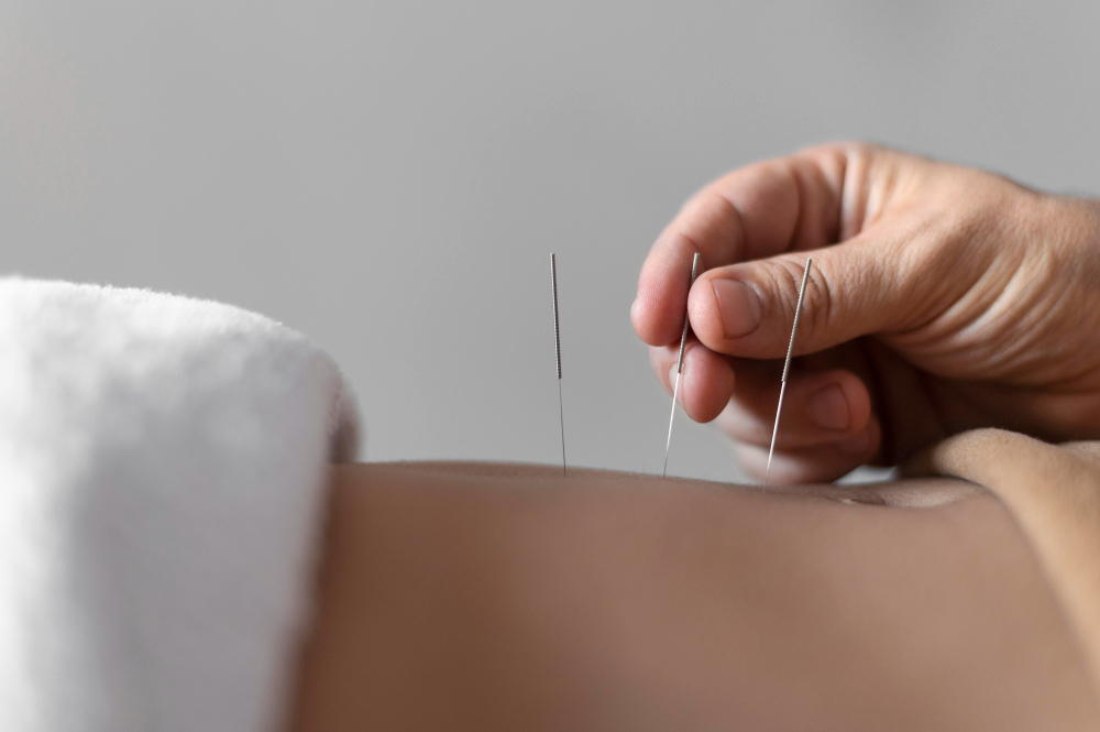 Acupuncture