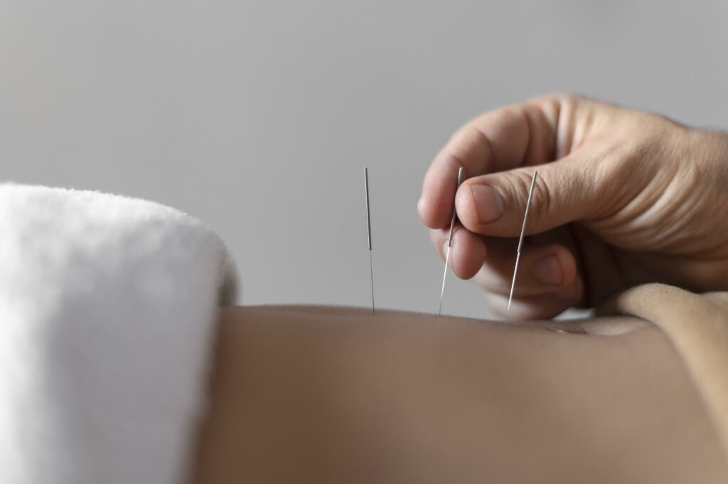 acupuncture Dublin