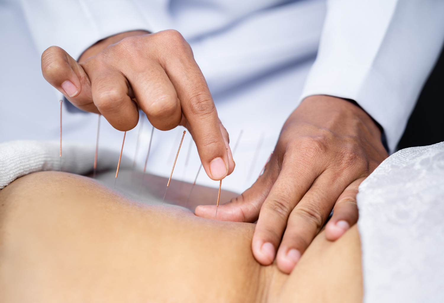 Achieve Your Fitness Goals With Acupuncture Therapy 1 Acupuncture Therapy Dublin