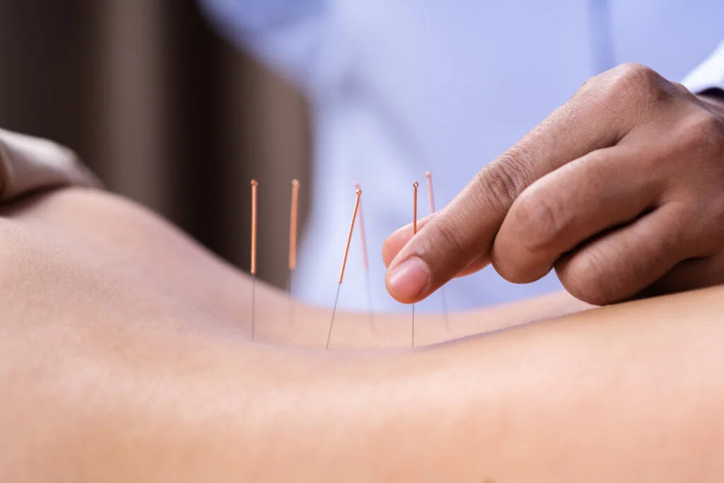 Achieve Your Fitness Goals With Acupuncture Therapy 1 Acupuncture Treatment Dublin