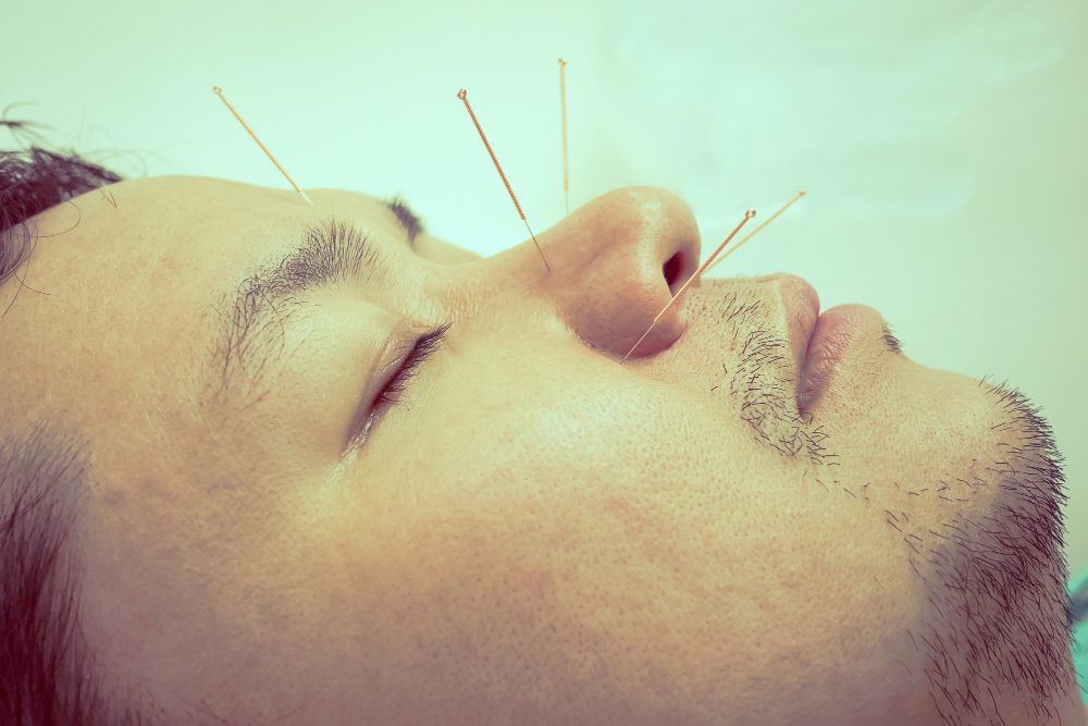 Acupuncture Treatment 