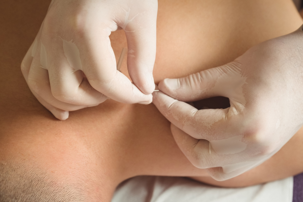 Acupuncture for Nerve Pain